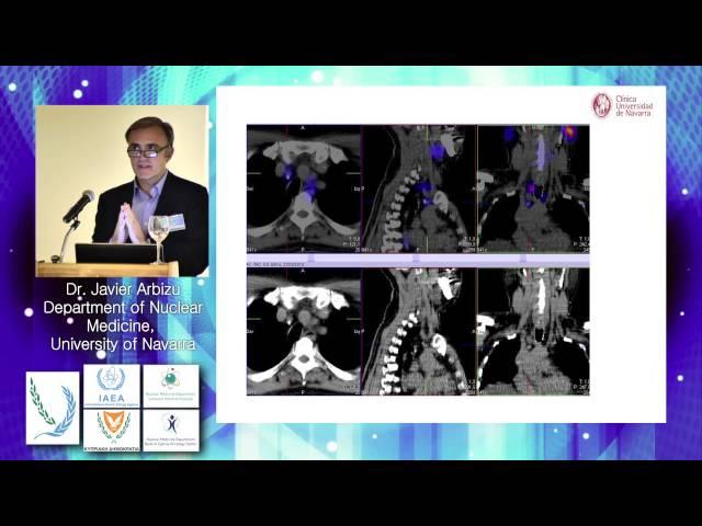 Wednesday, I-131 Whole Body Scan. SPECT/CT, Javier Arbizu