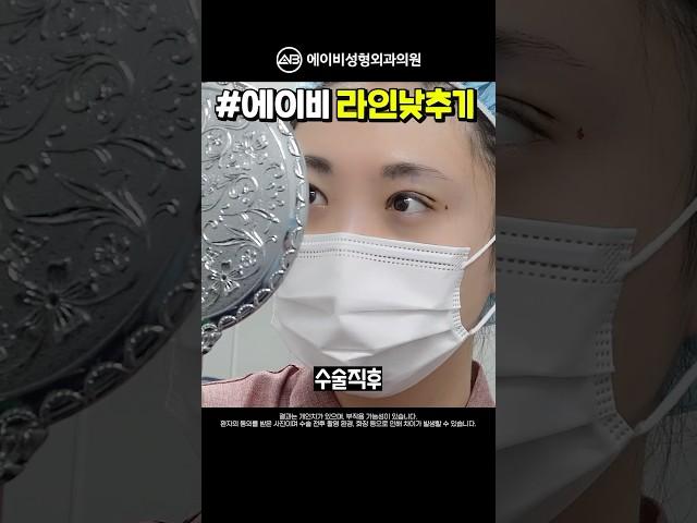 쌍꺼풀 라인낮추기 수술 2달 후기 #shorts