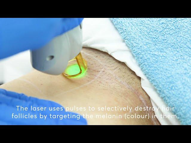 Laser Hair Removal Bikini: THIS is how it works