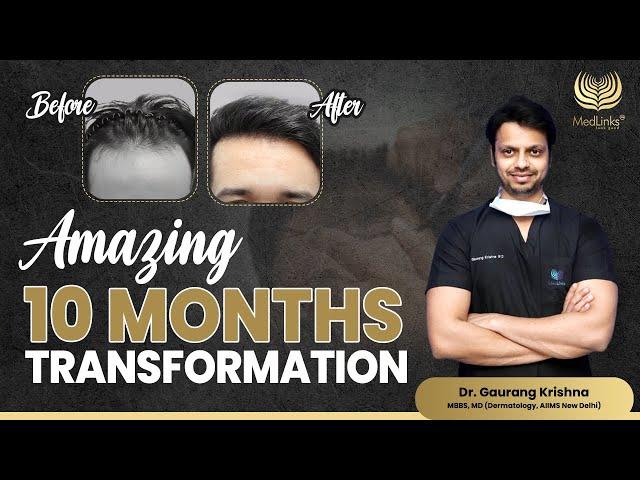 Amazing 10 Months Hair Transformation! | MedLinks