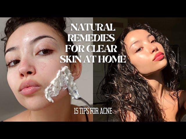 HOW TO MAINTAIN CLEAR SKIN WITHOUT SPENDING MONEY | 15 tips and tricks for acne