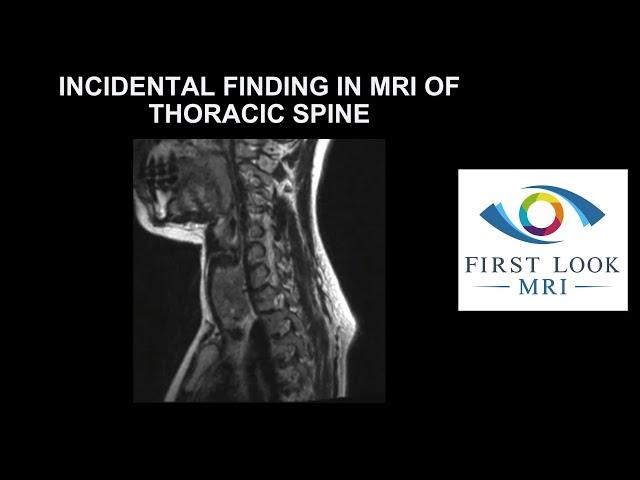 Incidental finding in MRI of thoracic spine