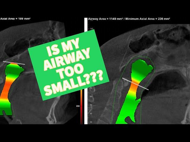 IS MY AIRWAY TOO SMALL?