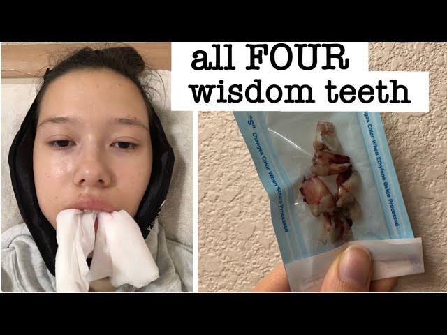 4 Wisdom Teeth Removed in 1 Day - My Recovery!