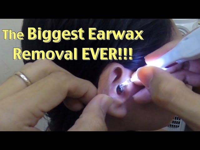 The Biggest Ear wax Removal EVER!!!