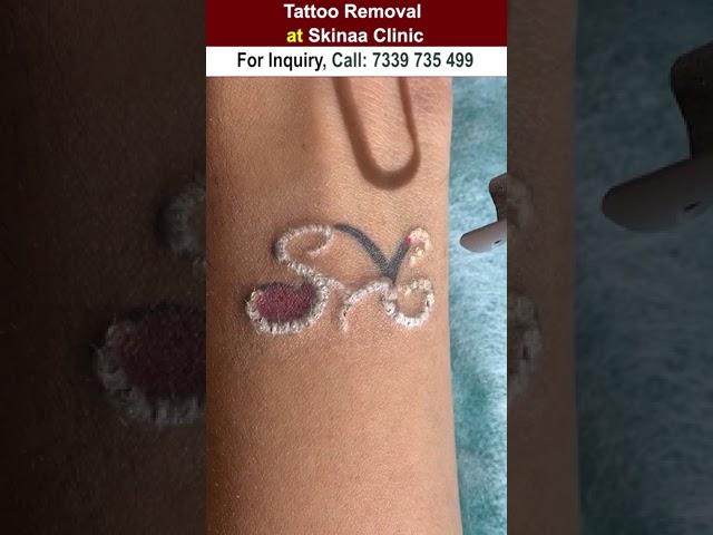 Tattoo removal at skinaa clinic #shorts