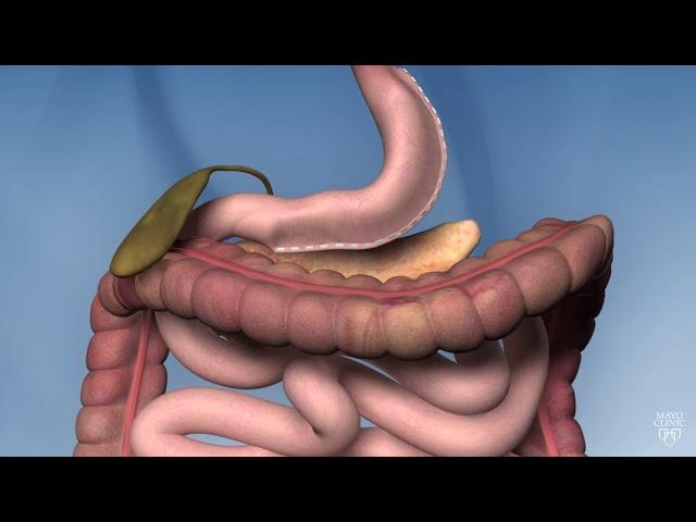 Sleeve Gastrectomy