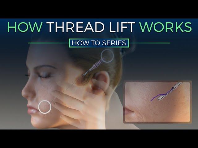 How Thread Lift Works - HOW TO SERIES