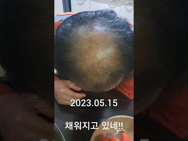 [탈모] 세상에 이런일이! ! !  장발의꿈