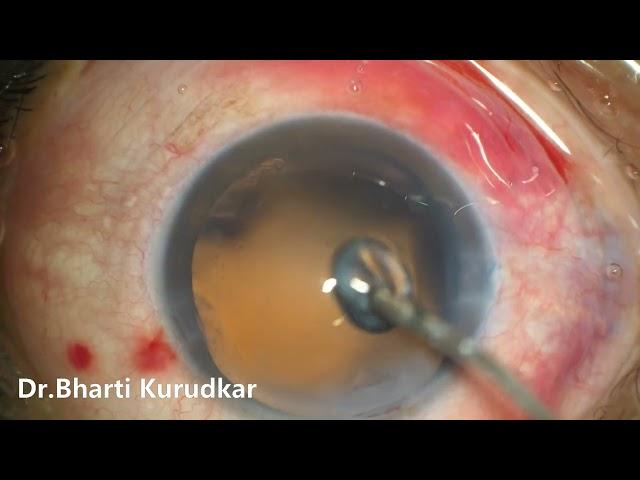 Phacoemulsification with implantation of Aurovue Multipiece Preloaded PCIOL