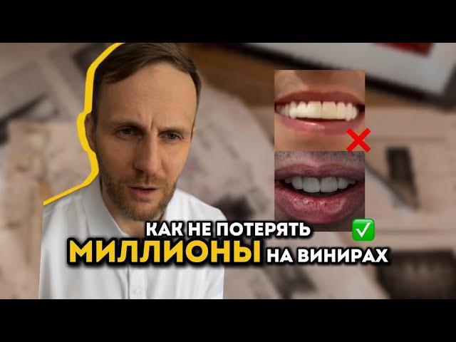 Керамические VS композитные виниры: Что выбрать? Мнение стоматолога