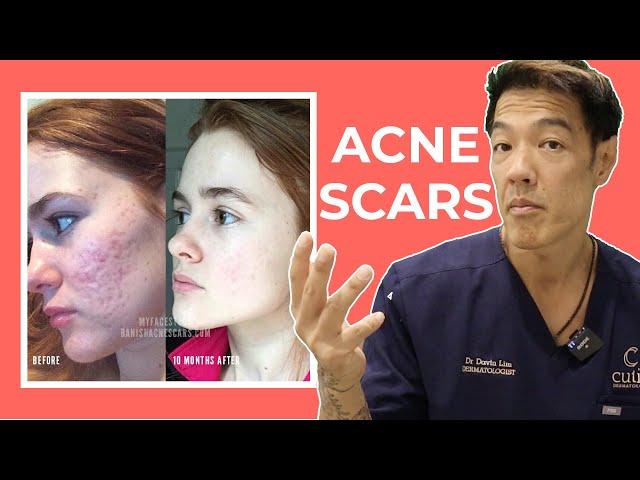 The Best Acne Scar Treatments: Explained | Dr Davin Lim