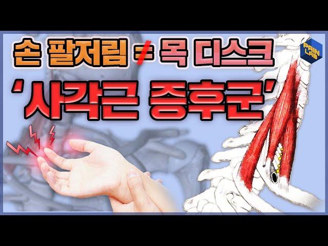 손, 팔 저림 증상 | 목 디스크가 아닌 '사각근 증후군'을 의심해라! | 중사각근 신경 이완법 | 스트레칭법