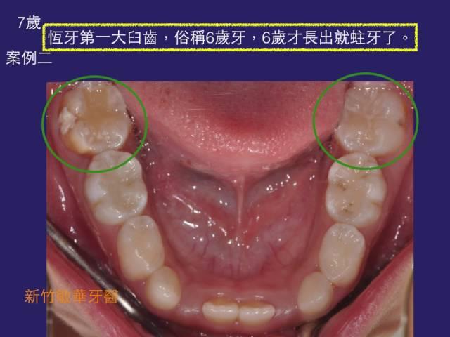 第一大臼齒蛀牙