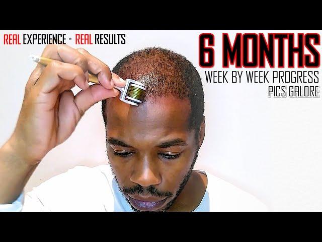 Derma roller Hair Regrowth Results 6 Months | Month by Month Progress | Coffee as a DHT Blocker