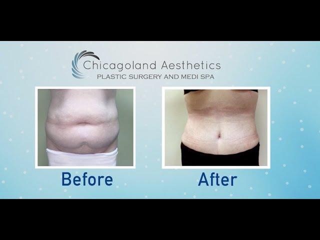 Liposuction 360 at Chicagoland Aesthetics | Plastic Surgery in Chicago