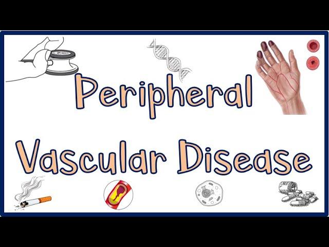 Peripheral Vascular Disease(PVD): Causes, Signs & Symptoms, Diagnosis &Treatment