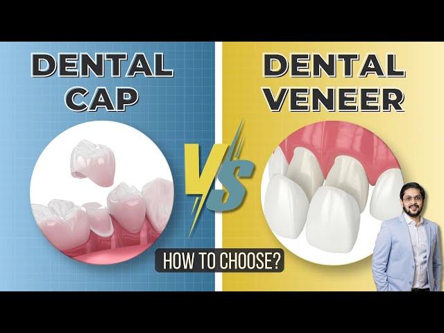 Dental Caps vs Veneers | Which is Right for Your Smile?