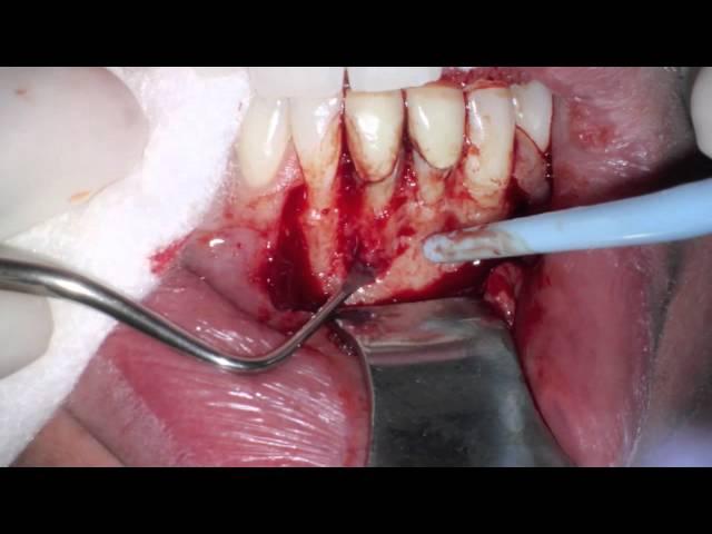 Lower Anterior Periapical Surgery