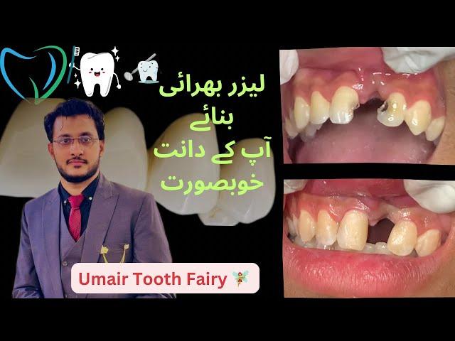 Composite filling #umairtoothfairy #dentist #umairazeem #satisfying #viral @Umairazeem8553