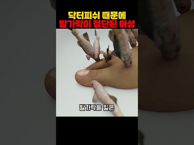 닥터피쉬 때문에 발가락이 절단된 여성