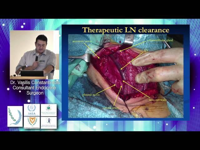 Tuesday, Thyroid and parathyroid Surgery – An overview, Vasilis Constantinidis