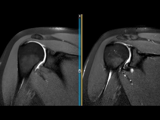 Fat suppressed T1 and Proton density images of shoulder