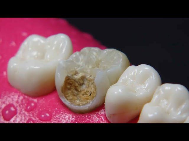 AMAZING dentist rebuilds tooth damaged by cavity: Endodontics + resin in 4K