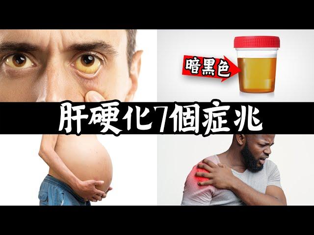 肝硬化,肝病末期7個症狀警訊,修護肝臟自然療法,柏格醫生 Dr Berg