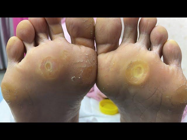 KETUAT KAKI SAKIT KENA LASER - DrMan Ttdi Live