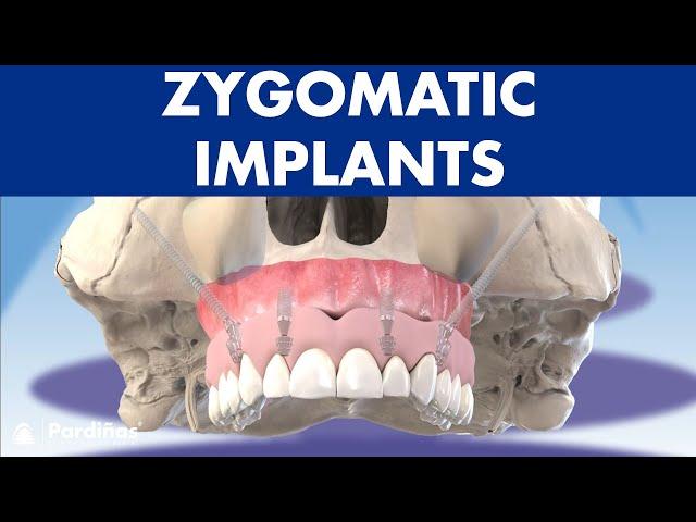 ZYGOMATIC implants - How to place dental implants without bone ©