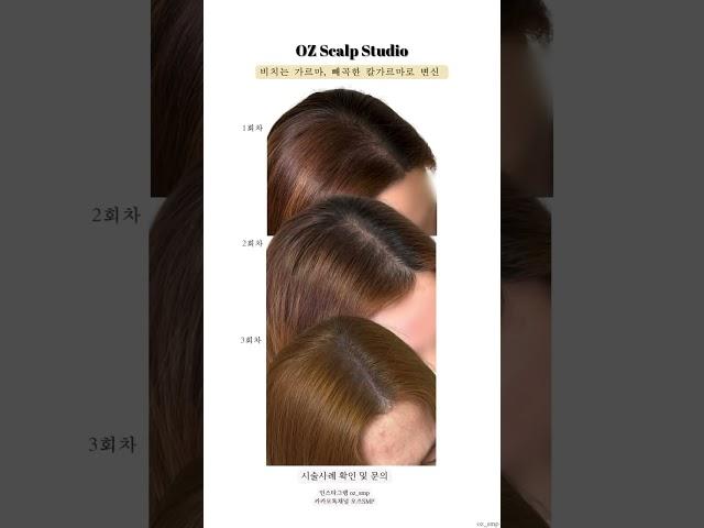 두피문신(SMP) 가르마 회차 별 변화 #두피문신 #SMP #인천두피문신 #부평두피문신