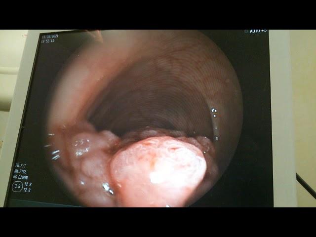 endoscopic pedonculated sigmoid polype resection