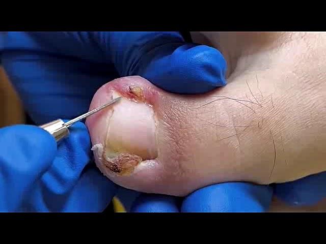 DIY Ingrown Toenail Removal | How to Safely Cut Ingrown Toenails at Home