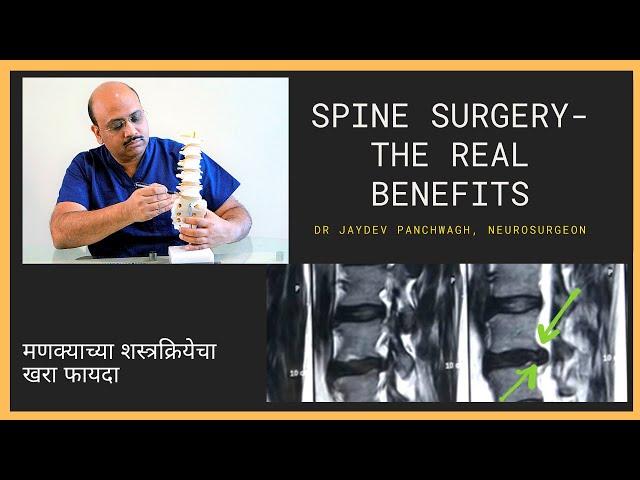 The Real Benefits of Spine Surgery for Nerve Compression | मणक्याच्या शस्त्रक्रियेचा खरा फायदा..