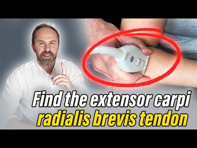 ECRB Scanning Tips for Tennis Elbow - SMUG MSKUS