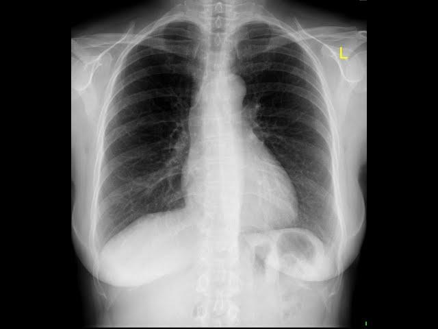 RADS.110  Anatomy of the Thoracic Viscera