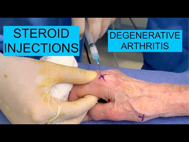 Steroid Injections for Degenerative Arthritis