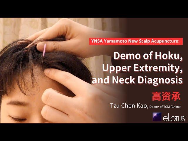 YNSA Yamamoto New Scalp Acupuncture: Demonstration of Hoku, Upper Extremity, and Neck Diagnosis