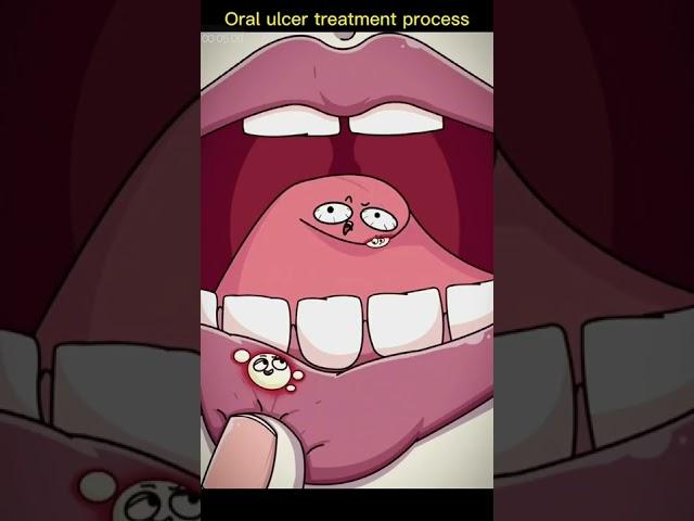 Oral ulcer treatment process