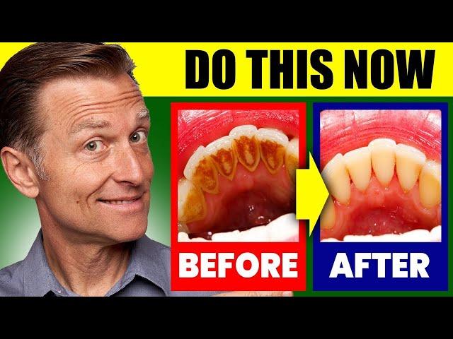 Natural Solution for Plaque, Cavities, and Gingivitis