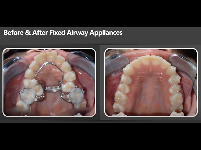 Airway Chat #1 with Dr Ben Miraglia: Airway Expansion Appliances (Palatal & Lower Expanders)