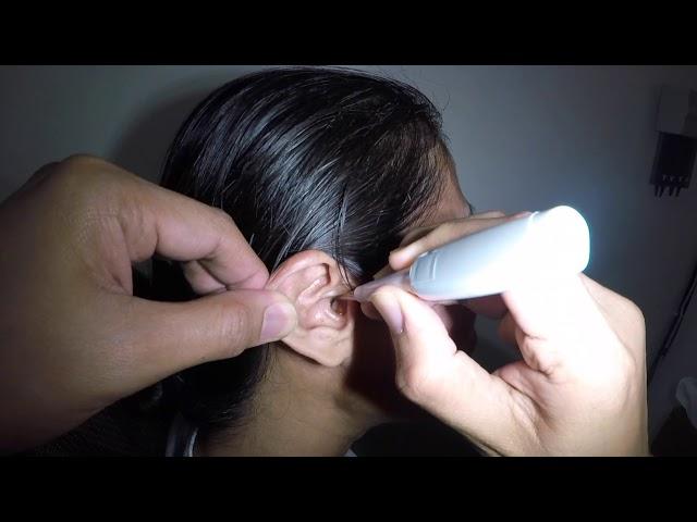 Woman's Earwax Removal - This is HUGE!