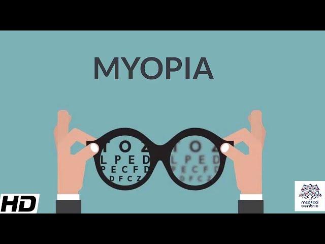 Myopia, Signs and Symptoms, Causes, Diagnosis and Treatment.