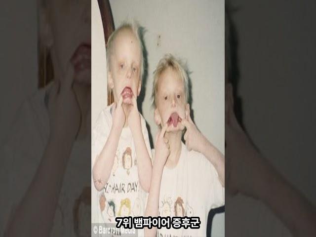 세계에서 가장 희귀한 질병 TOP 10