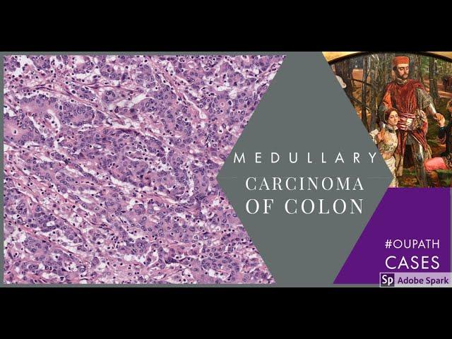 Medullary carcinoma of Colon