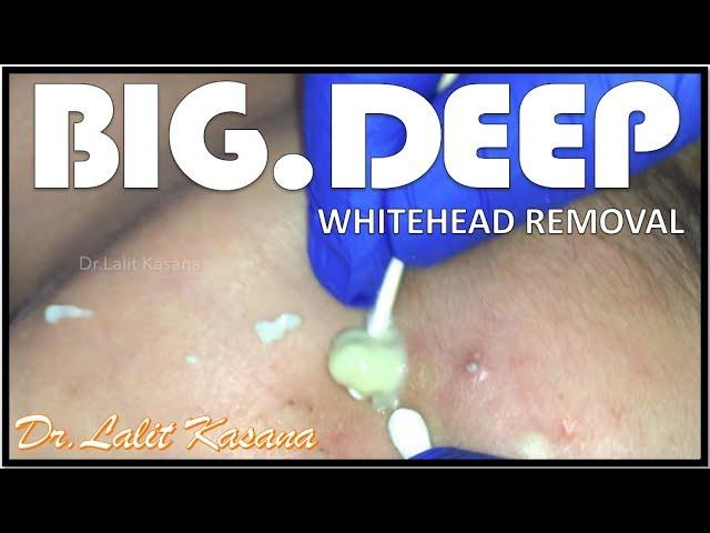 BIG DEEP WHITEHEADS AND SEBACEOUS CYST REMOVAL by Dr.Lalit Kasana