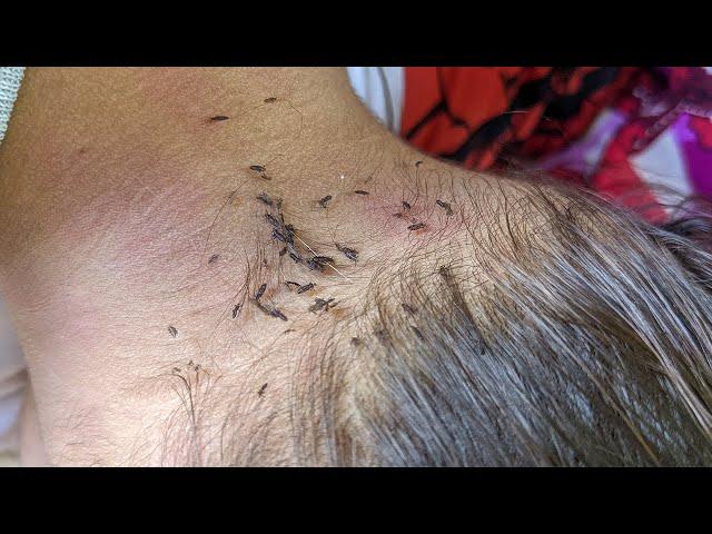 Removing all thousand lice from short hair - Pick out a lot of louse from head