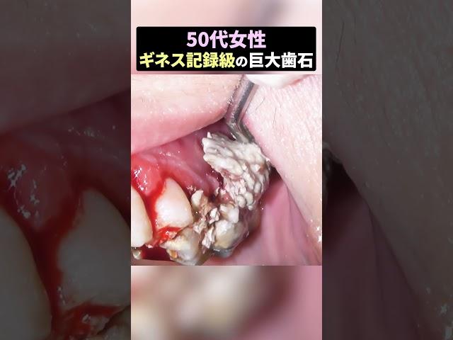 ギネス記録級の歯石がもう"歯岩"すぎる！！#歯石除去  #ザホワイトデンタルクリニック #歯医者