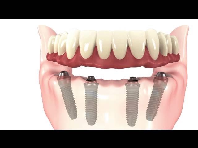 All-on-4 Dental Implants Simple Procedure Animation